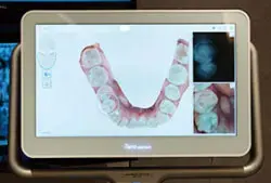 近赤外線で見る隠れ虫歯