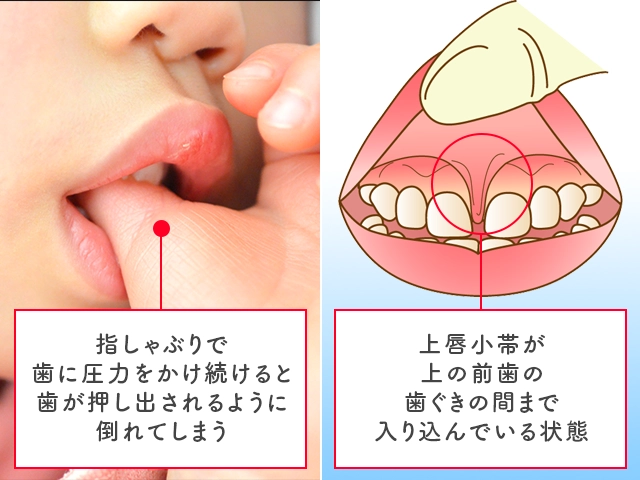 すきっ歯になりやすい原因