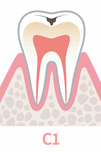 虫歯の進行