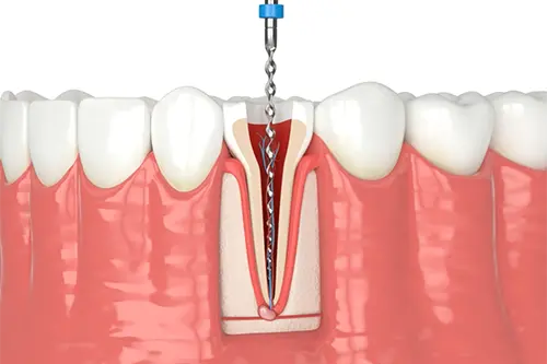 複雑な根管治療