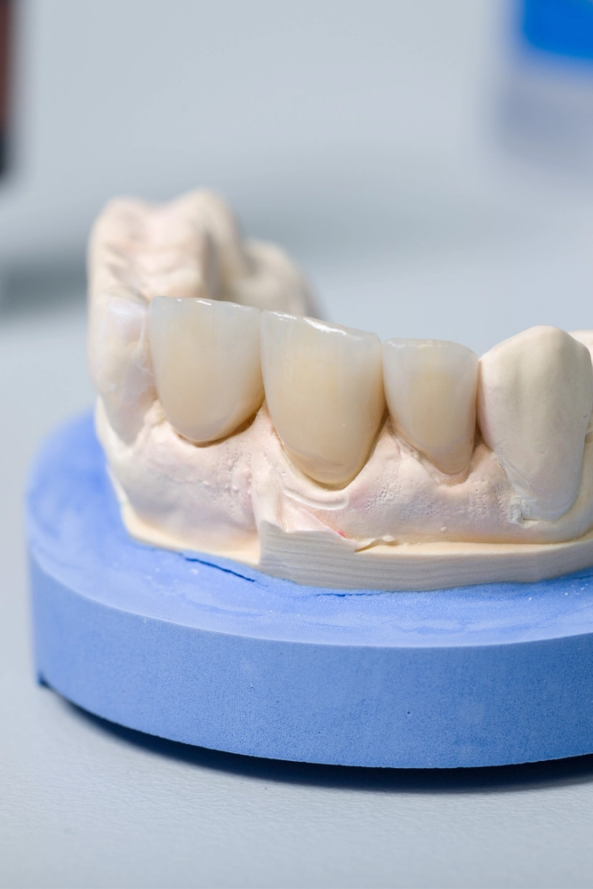 セラミックの前歯の被せ物を装着した模型