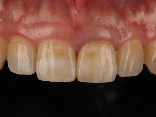 セラミック治療による自然な被せ物の装着後