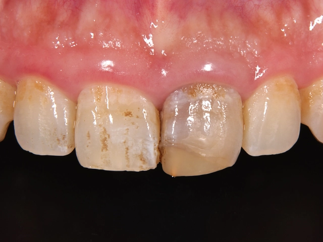 セラミック治療による被せ物の装着前