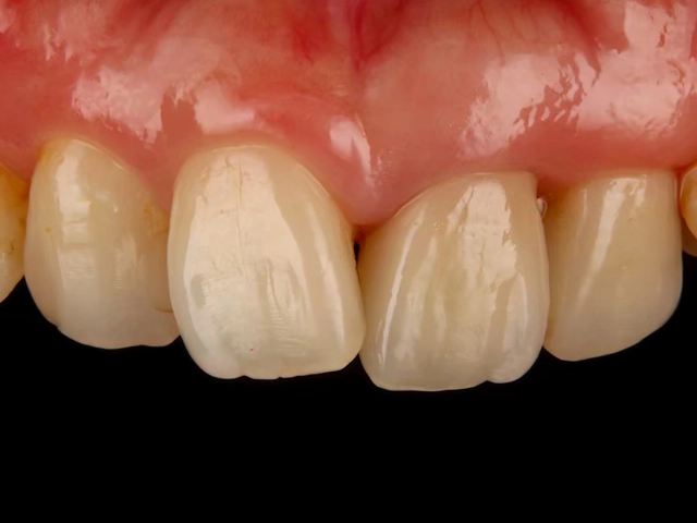 ジルコニアセラミック治療による自然な被せ物の装着後