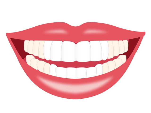 セラミック矯正で前歯のみをセラミックに置き換えた歯並び