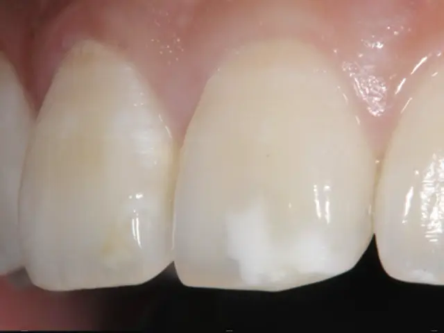 ホワイトスポットがある前歯