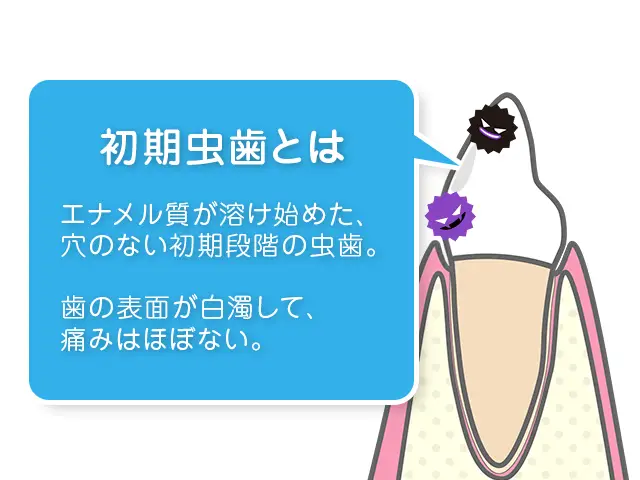 初期虫歯の説明