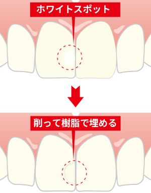 ダイレクトボンディングのイメージ