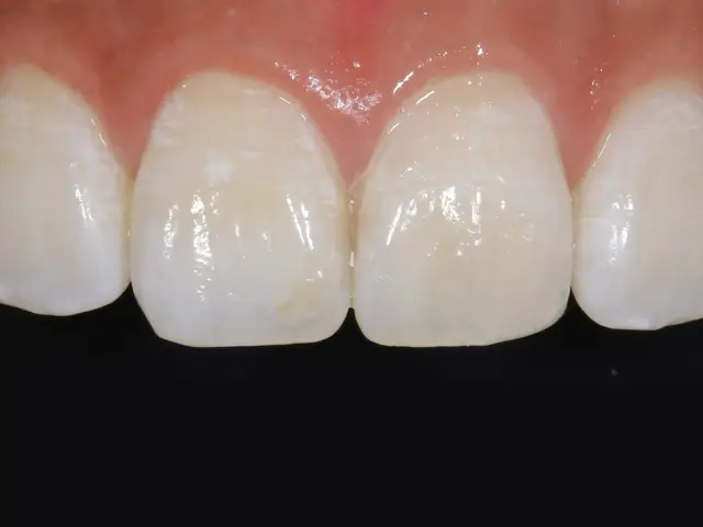 アイコン治療後