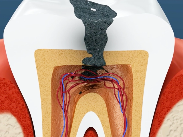 歯の神経まで達した虫歯