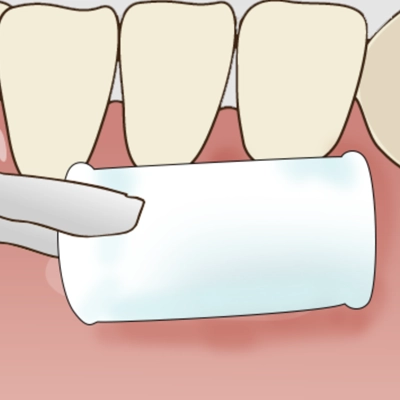 表面麻酔イメージ