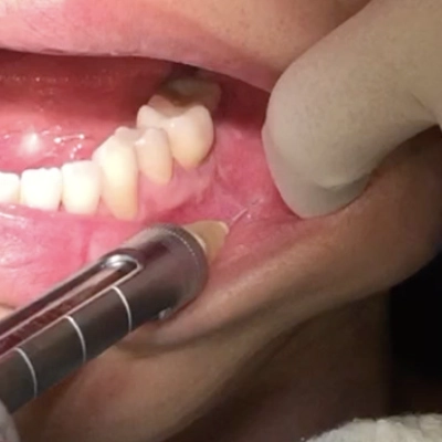 粘膜へ麻酔針を刺入する様子