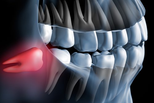 横向きに生えた親知らずのイメージ