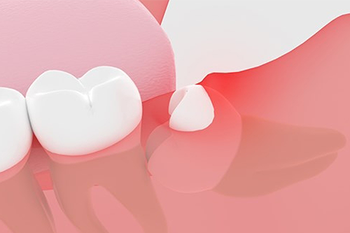 奥歯の歯茎が腫れているイメージ