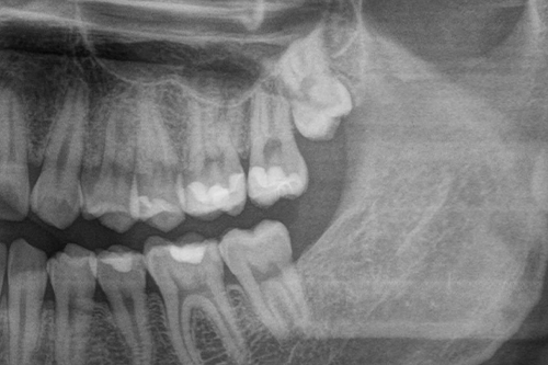 斜めに生えた親知らずのパノラマレントゲン