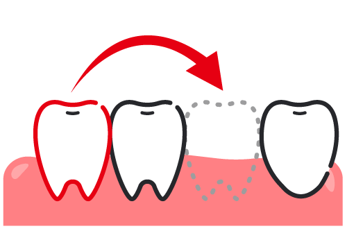 保存不可能になった奥歯の位置に親知らずを移植する自家歯牙移植の流れを示した図