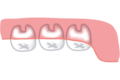 まっすぐ生えた上顎の親知らず（抜歯前）