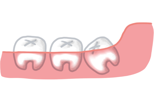 斜めに生えた下顎の親知らず（抜歯前）
