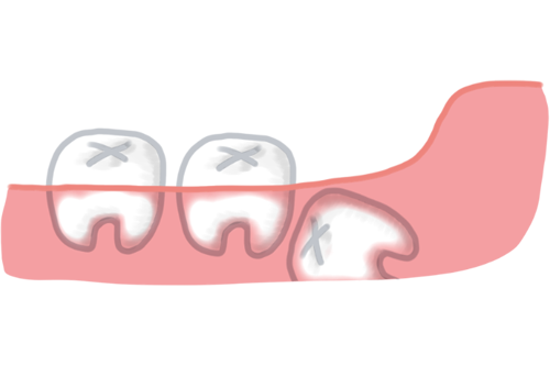 骨の中に完全に埋まった親知らず（抜歯前レントゲン）