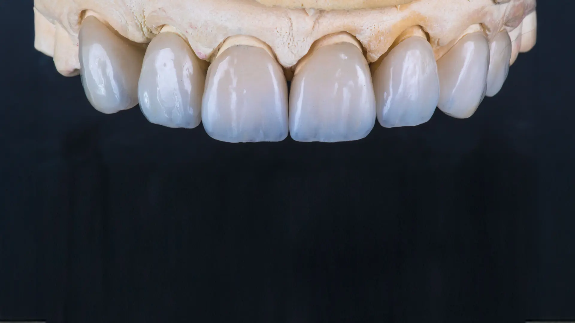 メタルフリー治療 | アップル歯科京都河原町